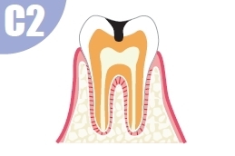 エナメル質の下にある象牙質に達した虫歯